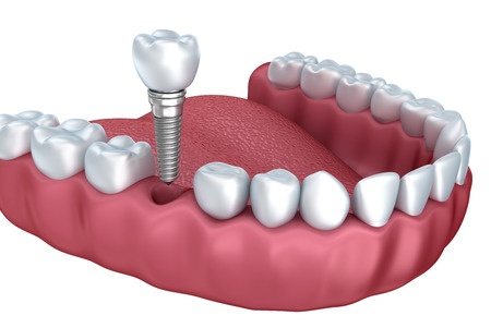 Tooth Implant